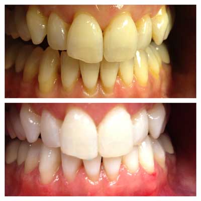 Teeth whitening with predictable science: a case study - KOR - I